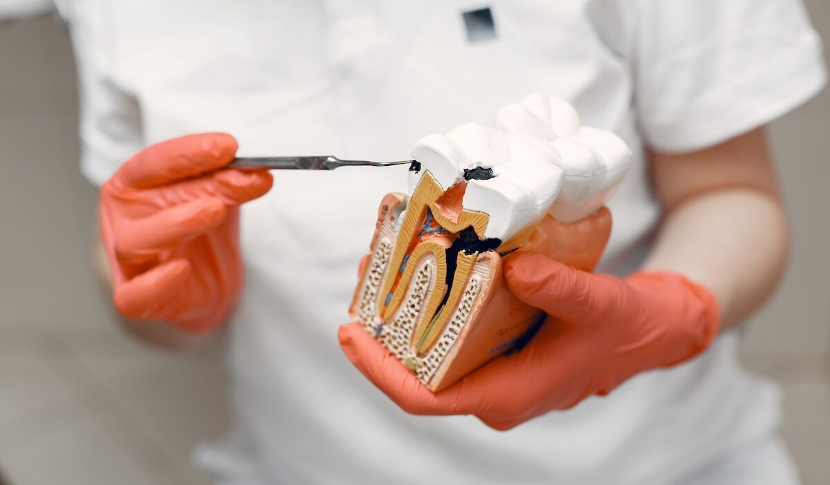does medicaid cover root canals