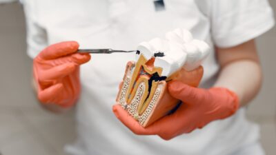 does medicaid cover root canals