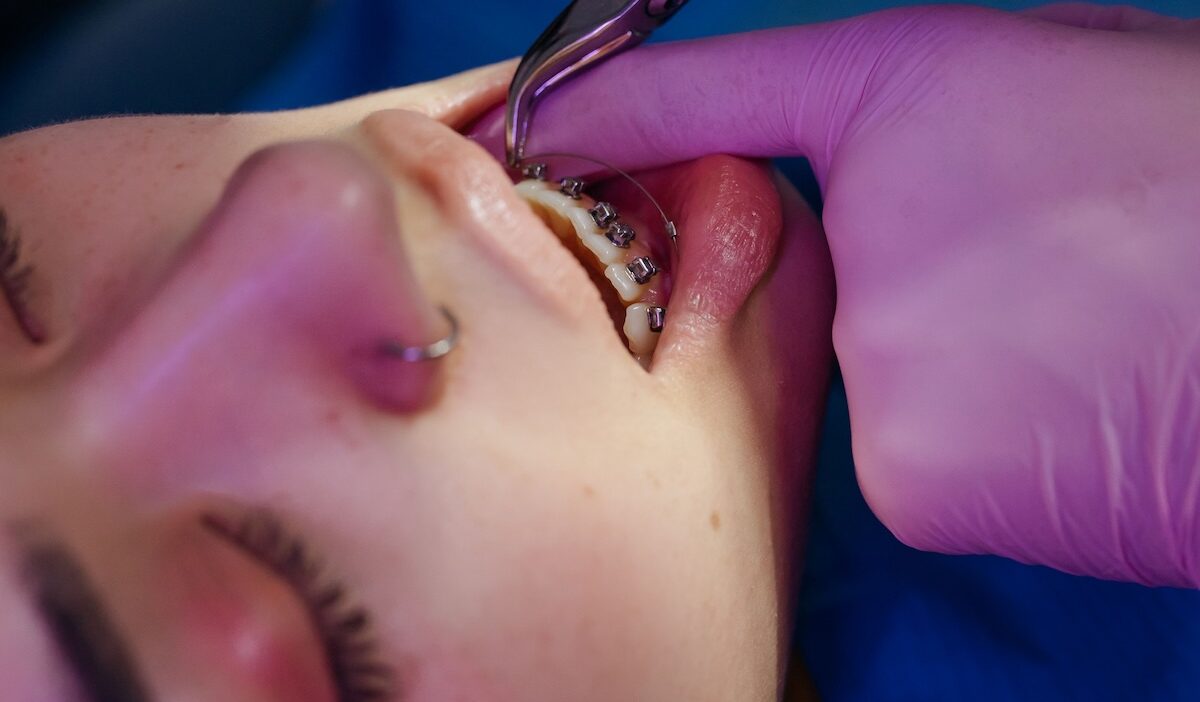 does medicaid cover braces in indiana