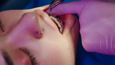 does medicaid cover braces in indiana