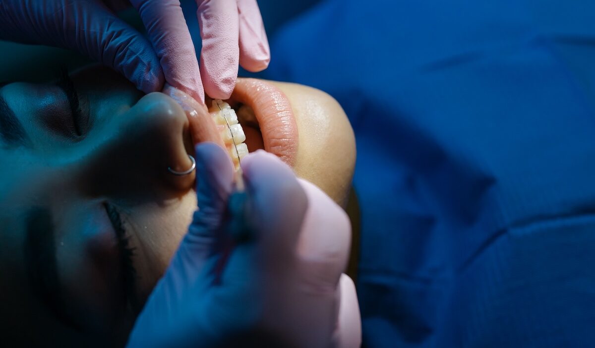 does medicaid pay for braces