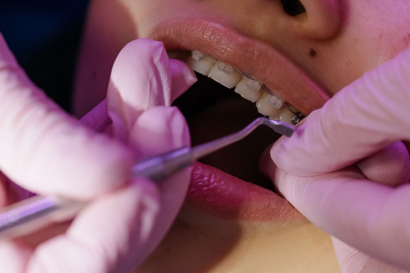 does Medicaid cover braces in Florida 2