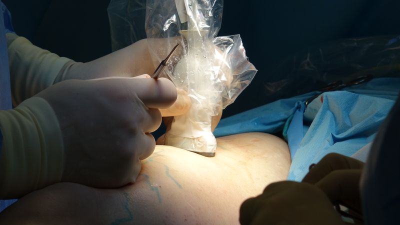 does-medicaid-cover-tummy-tuck